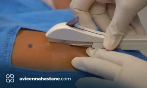 deri alti dogum kontrol avicenna