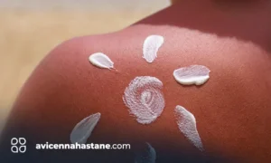 gunes yanigi en cabuk nasil gecer avicenna