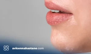 herpes nedir ucuk