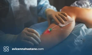 lazerle varis tedavisi nedir