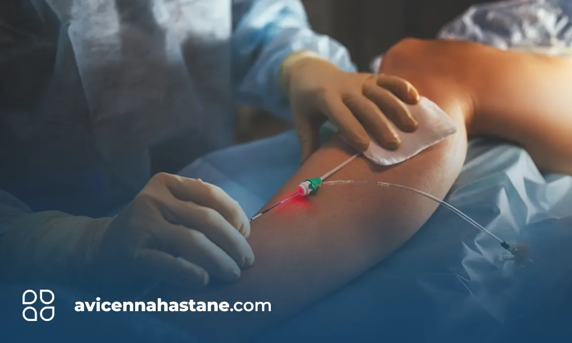 lazerle varis tedavisi nedir