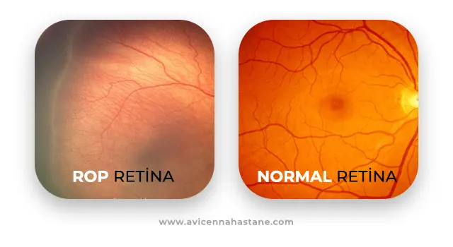 rop retina normal retina avicenna
