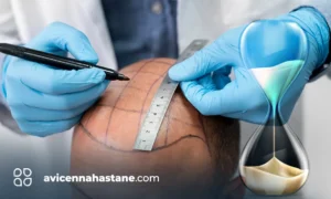 sac ekimi kac saat surer