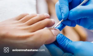 tirnak batmasi avicenna