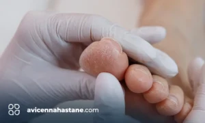 tirnak batmasi nedir