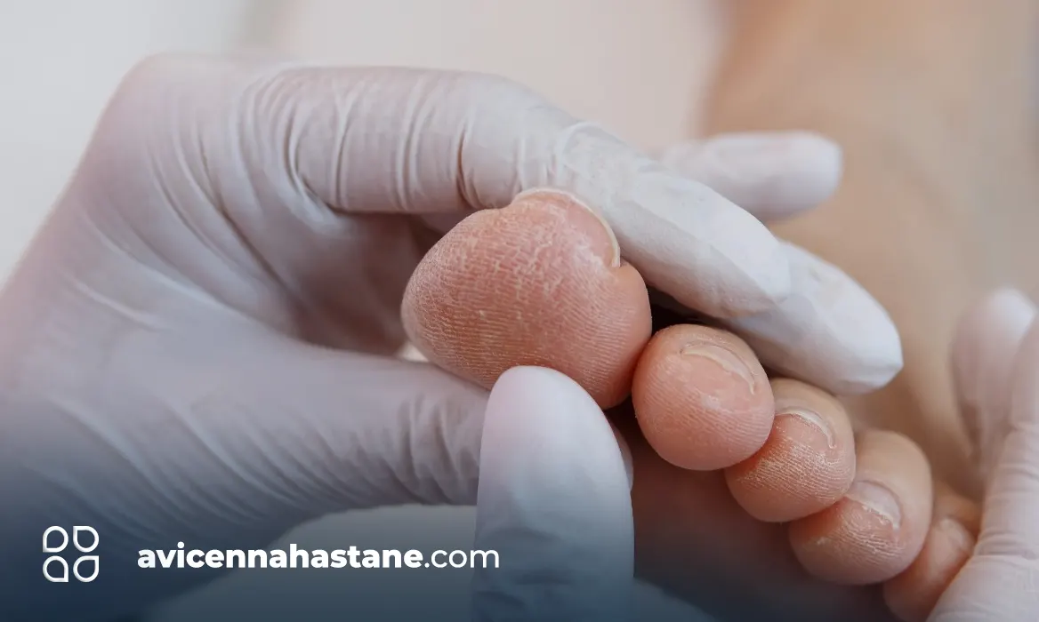 tirnak batmasi nedir