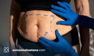 vaser lipsuction fiyatlari avicenna