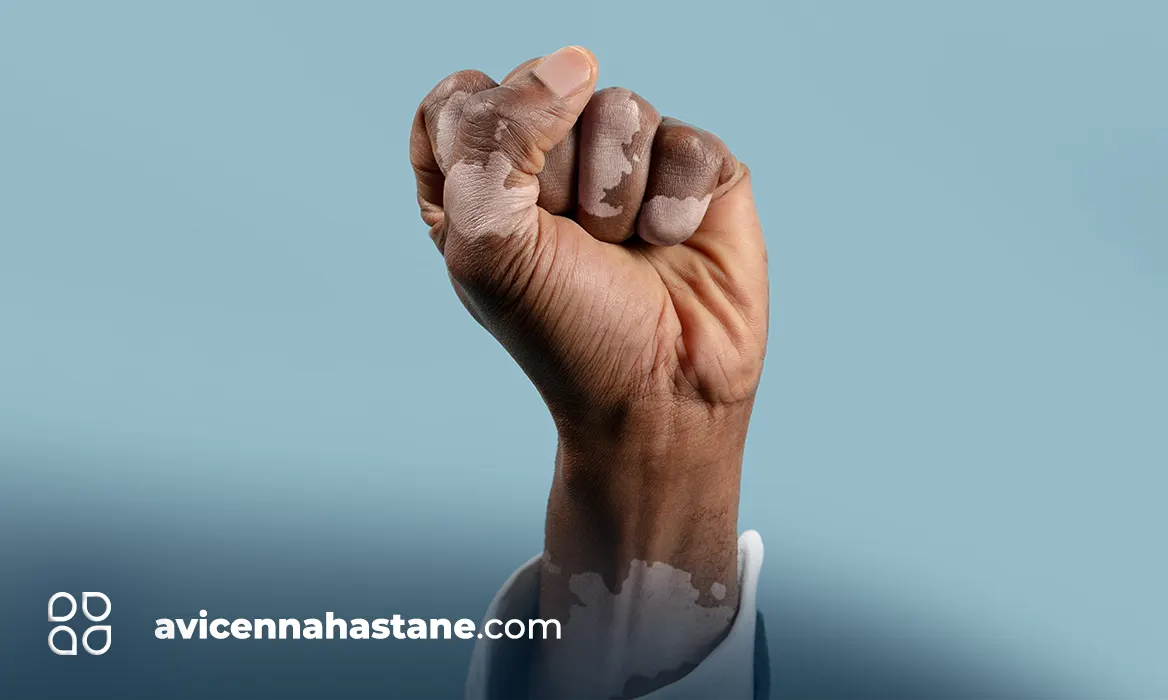 vilitigo nedir avicenna